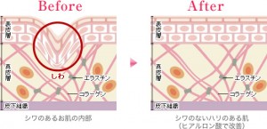 ヒアルロンさん！
